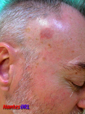 lesion