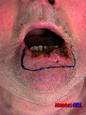 lesion