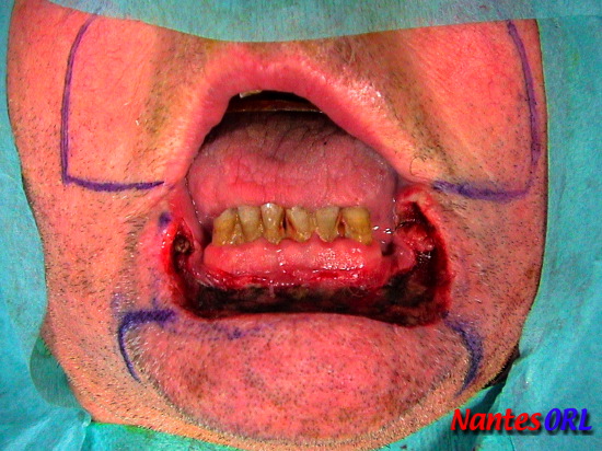 resection