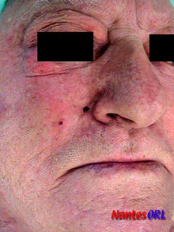 lesion