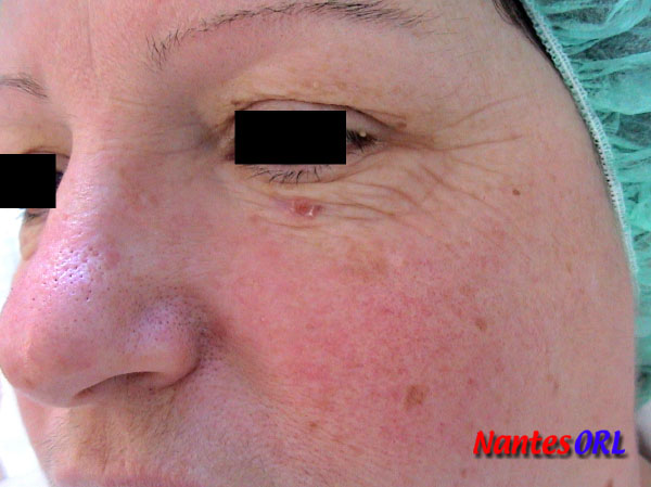 lesion1