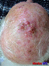 lesion