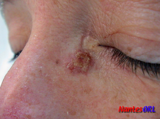 lesion2