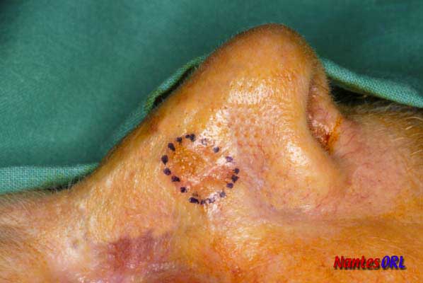 lesion