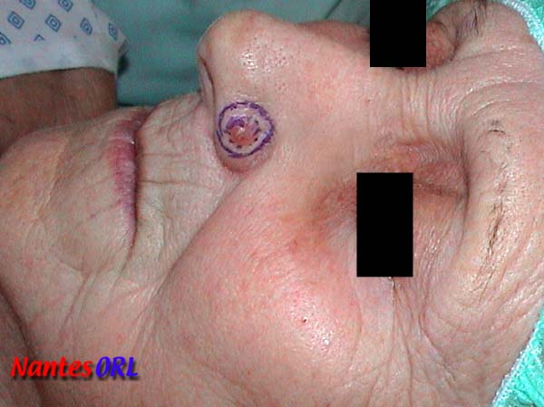 lesion