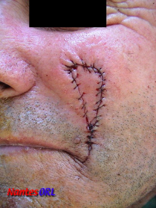 Suture.jpg