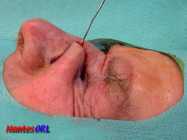 dissection