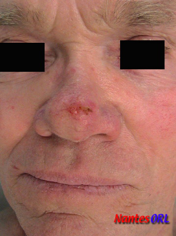 lesion.jpg