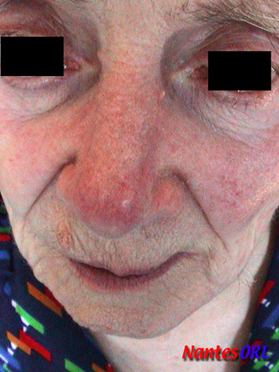 lesion3