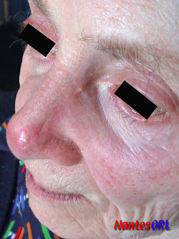 lesion3