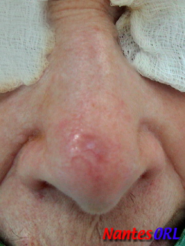 lesion