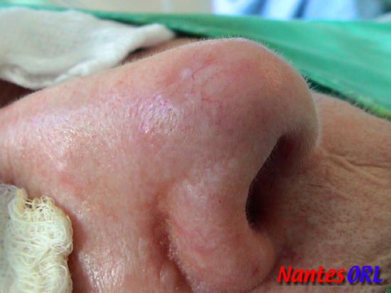 lesion2