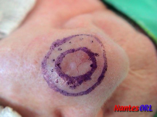 lesion3