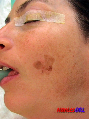 lesion