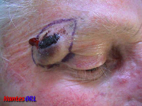 lesion