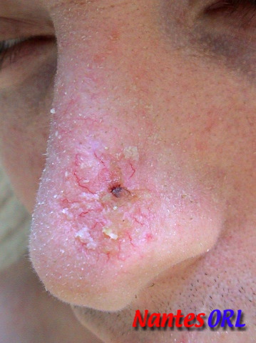 scleroderm