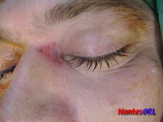 basoscleroderm