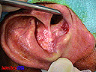 lesion2