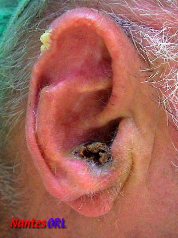 lesion