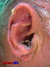 lesion