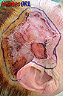 lesion