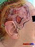 lesion2