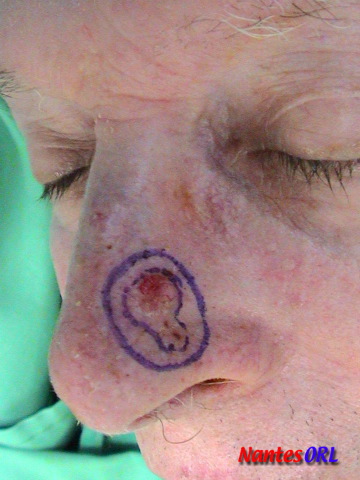 lesion