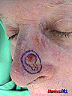 lesion