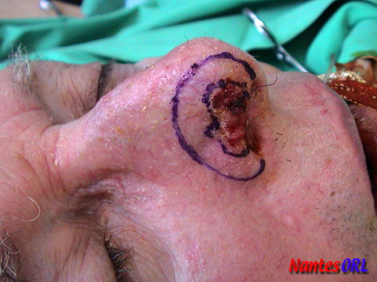 lesion