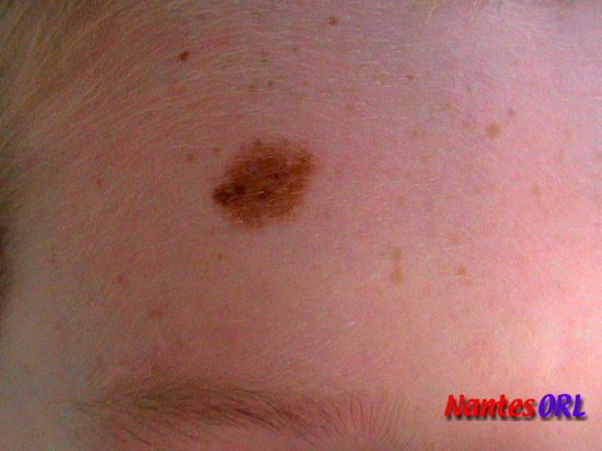 lesion2