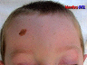lesion