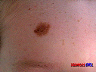lesion2