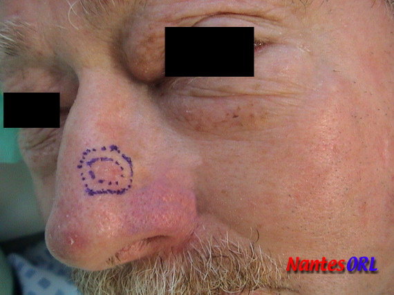 lesion.jpg